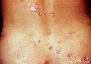 女性梅毒吃瓜,女性梅毒患者的生活挑战与自我关爱之路